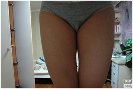 未吸脂之前 未吸脂之前