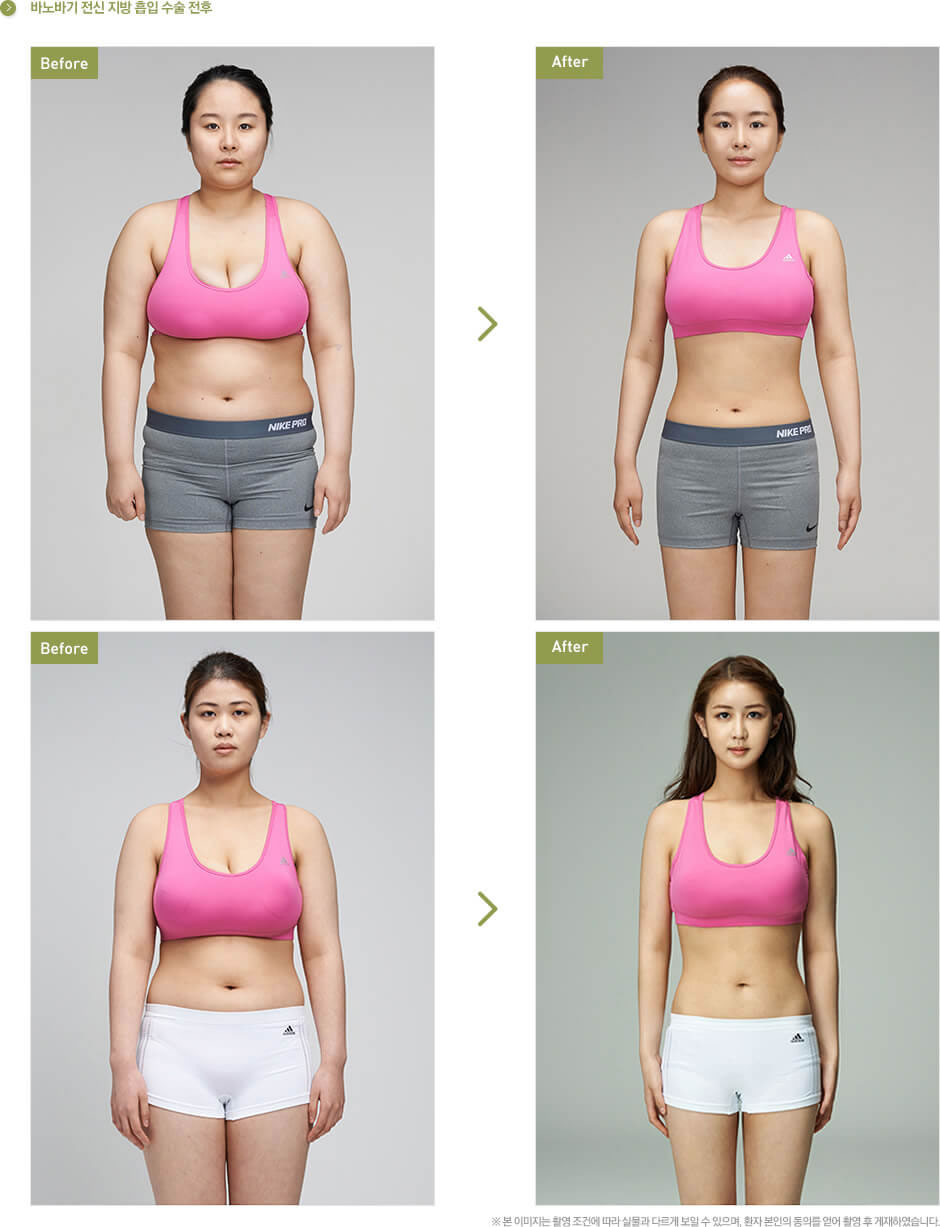 韩国巴诺巴奇整形医院瘦身案例 韩国巴诺巴奇整形医院瘦身案例