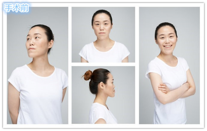 韩雪熙术前照 韩雪熙术前照