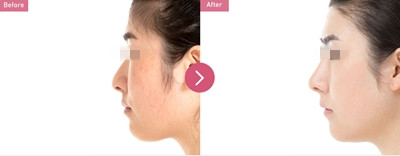 巴诺巴奇整形医院鼻整形案例2 巴诺巴奇整形医院鼻整形案例2