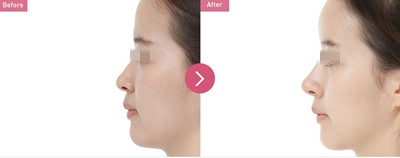 巴诺巴奇整形医院鼻整形案例1 巴诺巴奇整形医院鼻整形案例1