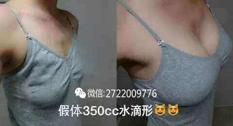 假体隆胸案例对比图 假体隆胸案例对比图