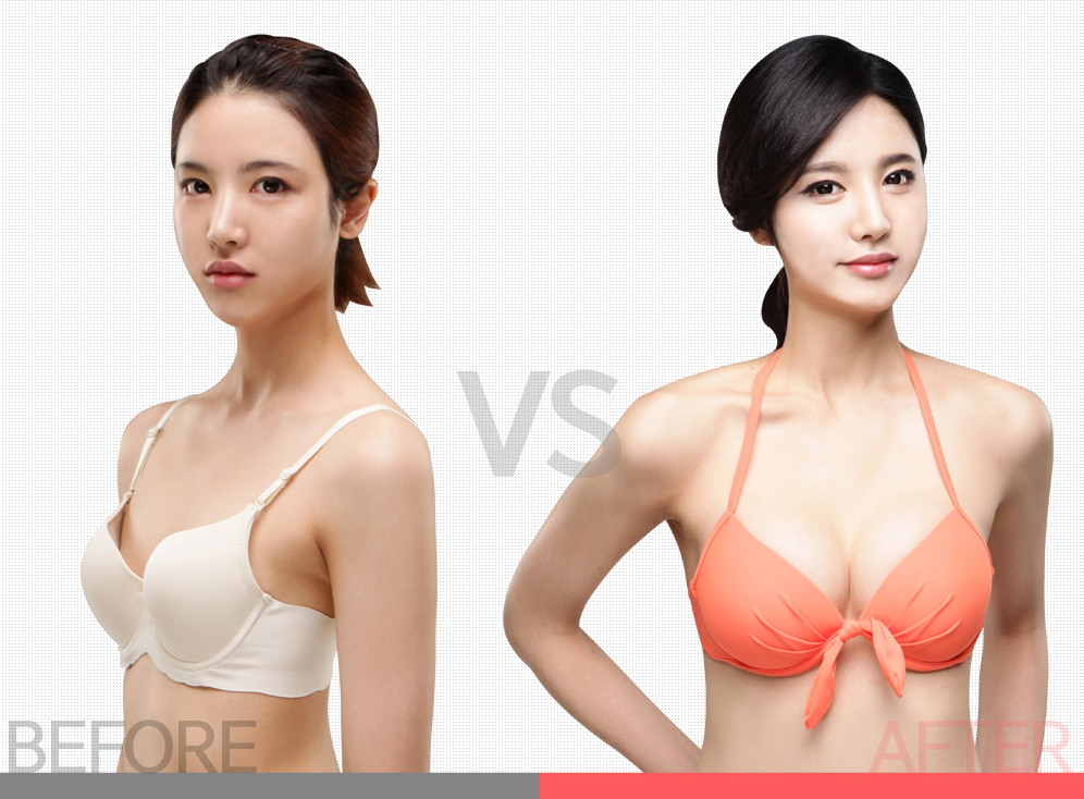韩国爱我整形医院隆胸前后对比案例 韩国爱我整形医院隆胸前后对比案例