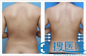 吸脂手术案例 吸脂手术案例