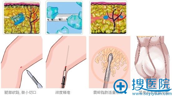 吸脂手术流程 吸脂手术流程