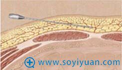 术前(黄色是脂肪) 术前(黄色是脂肪)