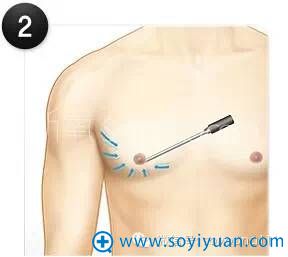 用超声波设备去除及分解多余不需要的脂肪 用超声波设备去除及分解多余不需要的脂肪
