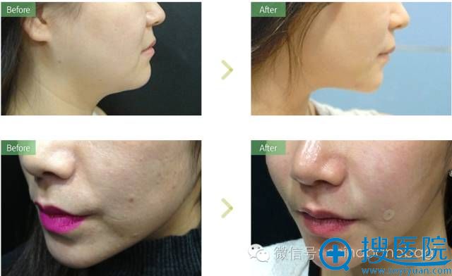 韩国巴诺巴奇提升案例对比效果图 韩国巴诺巴奇提升案例对比效果图