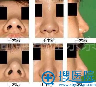 中北信昭鼻部整形案例手术前后对比图2 中北信昭鼻部整形案例手术前后对比图2