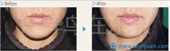 中北信昭面部轮廓整形案例3:下巴过长削骨手术对比图 中北信昭面部轮廓整形案例3:下巴过长削骨手术对比图