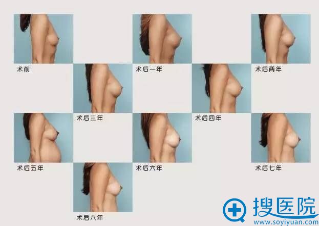 傲诺拉假体术前到术后7年效果 傲诺拉假体术前到术后7年效果