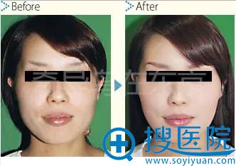 中北信昭面部轮廓削骨案例1:下颌角削骨前后对比照片 中北信昭面部轮廓削骨案例1:下颌角削骨前后对比照片