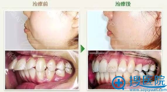 中北信昭面部轮廓整形案例3:正颌手术 中北信昭面部轮廓整形案例3:正颌手术