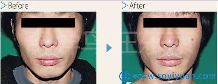 中北信昭面部轮廓案例2:颧骨内推案例对比图片 中北信昭面部轮廓案例2:颧骨内推案例对比图片