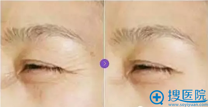 瘦脸针除皱瘦脸针除皱案例一 瘦脸针除皱瘦脸针除皱案例一