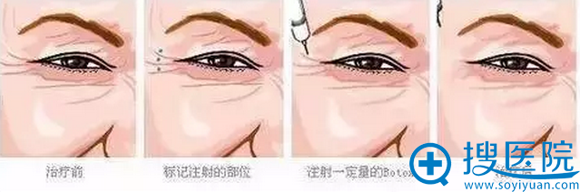 除皱流程 除皱流程