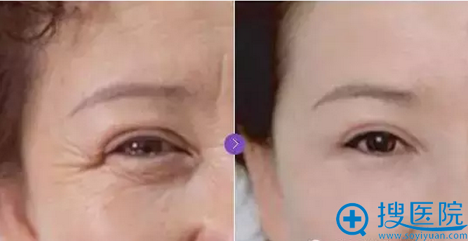 瘦脸针除皱瘦脸针除皱案例二 瘦脸针除皱瘦脸针除皱案例二