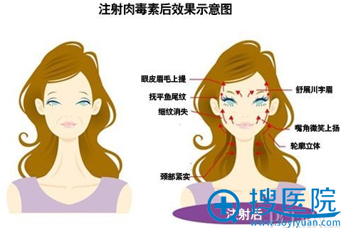 瘦脸针除皱效果示意图 瘦脸针除皱效果示意图