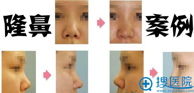 木村院长做的隆鼻手术照片 木村院长做的隆鼻手术照片