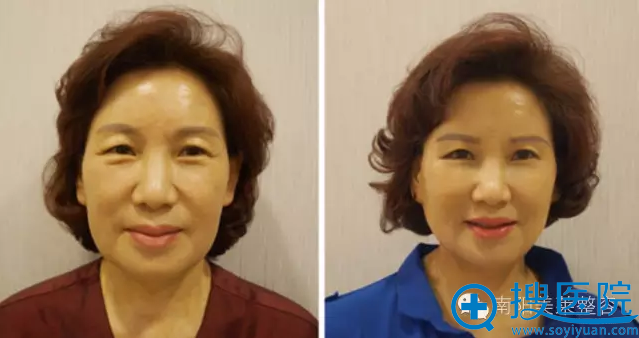 南阳美莱V-Loc线雕焕颜术真人案例 南阳美莱V-Loc线雕焕颜术真人案例