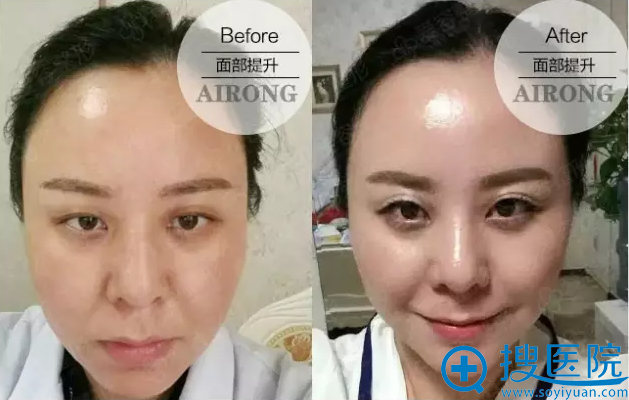 南阳美莱V-Loc面部提升真人案例 南阳美莱V-Loc面部提升真人案例