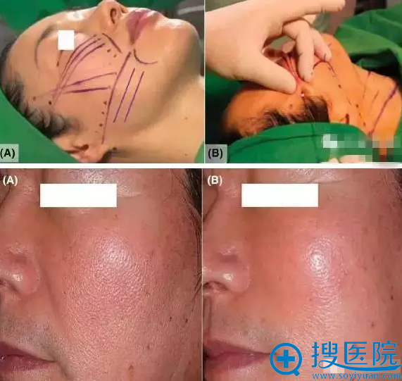 南阳美莱整形 V-Loc线雕焕颜术过程 南阳美莱整形 V-Loc线雕焕颜术过程