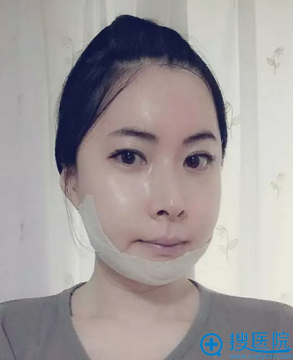 美妞术后照 美妞术后照