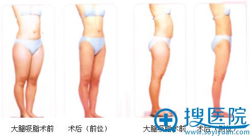 全身吸脂 全身吸脂