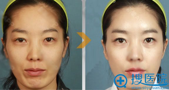 除皱案例 除皱案例