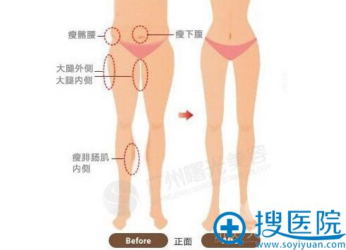 全身吸脂部位 全身吸脂部位