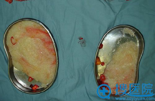 手术取出奥美定 手术取出奥美定