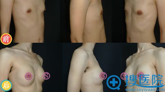 脂肪+假体+人工真皮修复效果 脂肪+假体+人工真皮修复效果