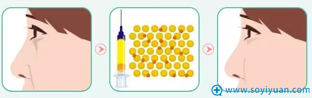 自体脂肪编码植入适量 自体脂肪编码植入适量