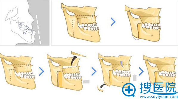 4D均衡双鄂手术流程 4D均衡双鄂手术流程