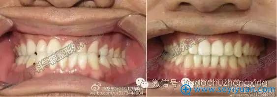 正颌手术前后对比 正颌手术前后对比