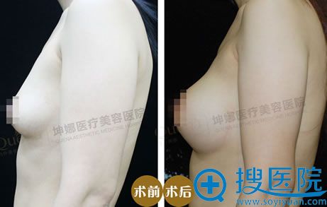 隆胸案例 隆胸案例