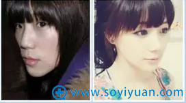 对比强烈的术前术后图 对比强烈的术前术后图