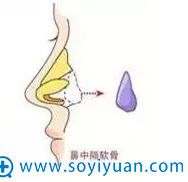 鼻中隔软骨隆鼻尖 鼻中隔软骨隆鼻尖