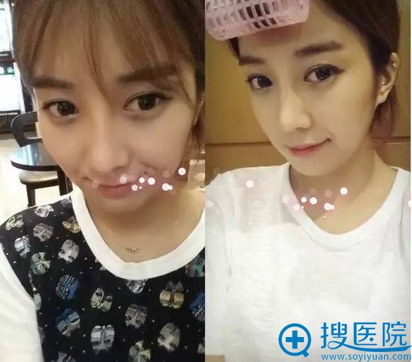 这是较近的照片,现在想想维多利亚的医生真的很专业效果超好 这是较近的照片,现在想想维多利亚的医生真的很专业效果超好