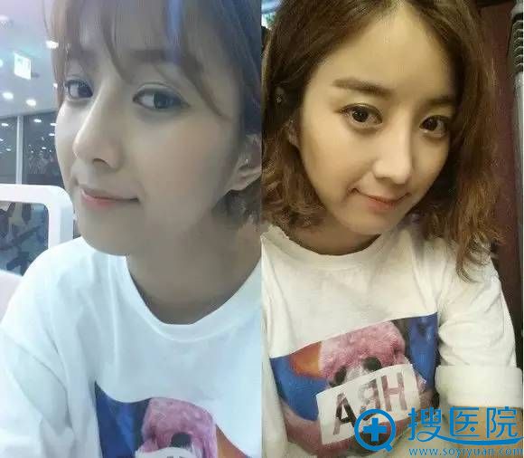 在南京维多利亚整形医院做双眼皮+隆鼻手术一个月 在南京维多利亚整形医院做双眼皮+隆鼻手术一个月