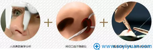 南京维多利亚宫廷鼻雕术的过程 南京维多利亚宫廷鼻雕术的过程