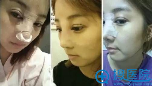 在南京维多利亚整形医院做了双眼皮+隆鼻手术当天 在南京维多利亚整形医院做了双眼皮+隆鼻手术当天