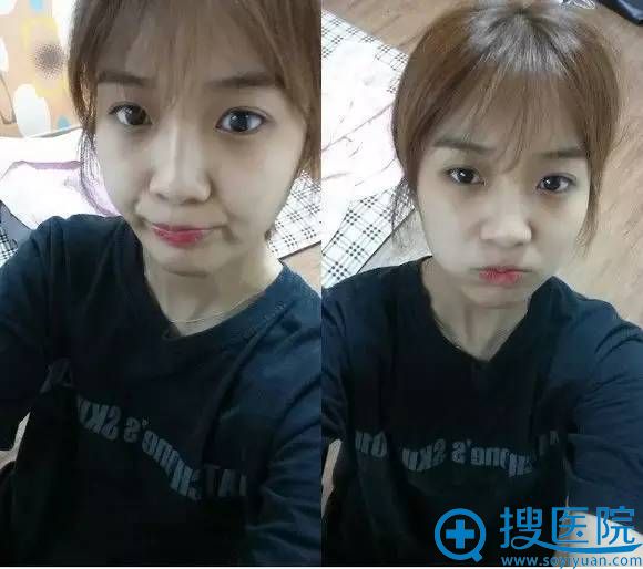 在南京维多利亚整形医院做了双眼皮+隆鼻手术亲身经历整形日记 在南京维多利亚整形医院做了双眼皮+隆鼻手术亲身经历整形日记