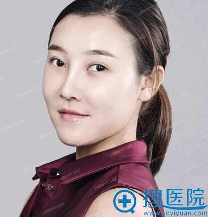 鼻修复术后两周了,气质都变好了 鼻修复术后两周了,气质都变好了