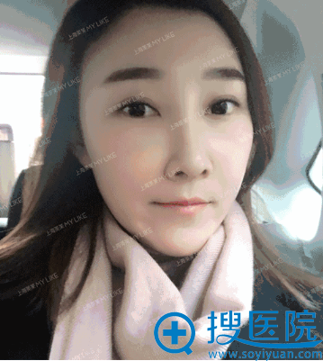 鼻修复术后1个月效果,再也不用p图了 鼻修复术后1个月效果,再也不用p图了