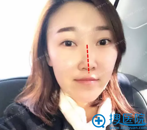 这是术前,鼻假体移位了 这是术前,鼻假体移位了