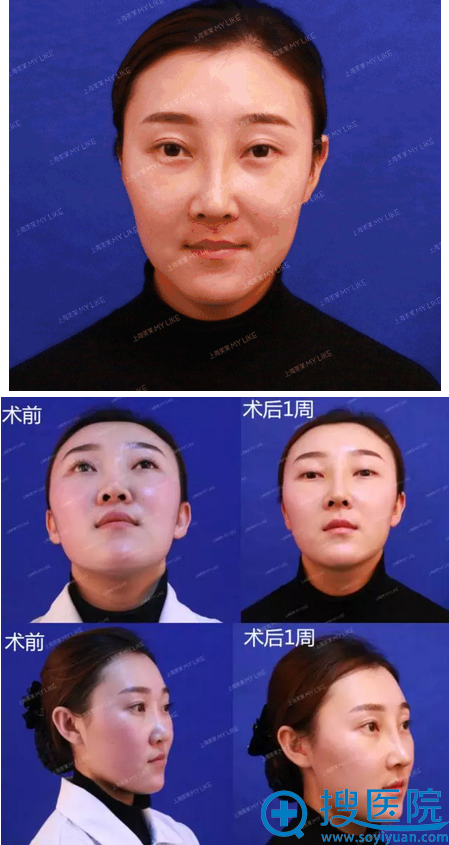 鼻修复术后一周,恢复的超好 鼻修复术后一周,恢复的超好