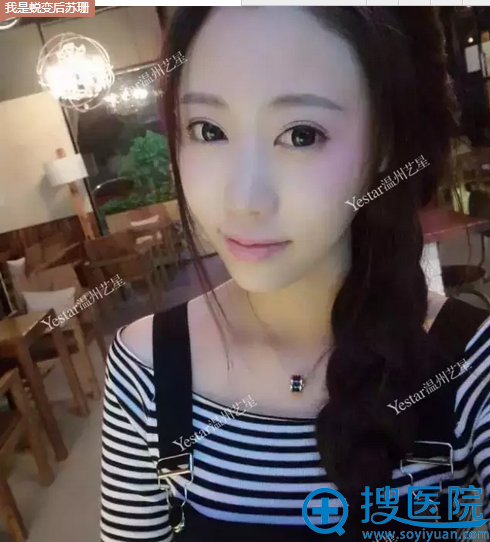 玻尿酸填充了法令纹、苹果肌后的效果 玻尿酸填充了法令纹、苹果肌后的效果