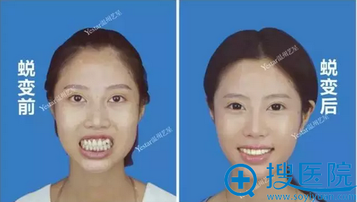 龅牙矫正术前术后对比照片 龅牙矫正术前术后对比照片