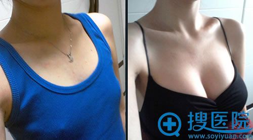 在日本做假体隆胸前后对比照片 在日本做假体隆胸前后对比照片